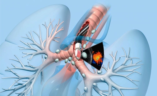 Endobronşiyal Ultrasonografi (EBUS) Nasıl Yapılır?